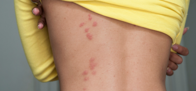 Same Day bedbug treatment in Milton Keynes